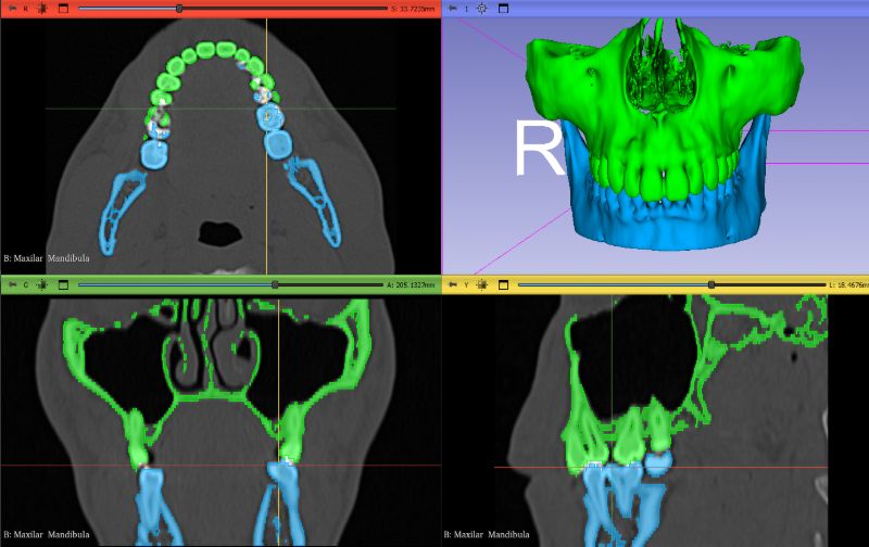 Archivo STL — Mandíbula y maxilar en 3D Slicer